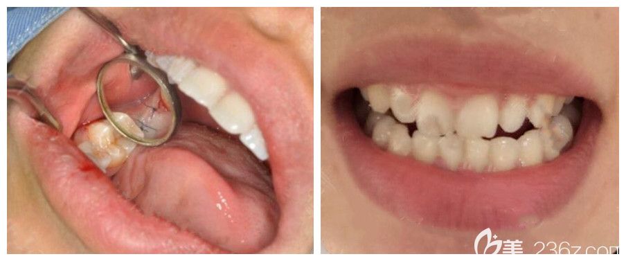 青岛维乐口腔梁腾医生单颗种植牙案例 青岛维乐口腔梁腾医生单颗种植牙案例