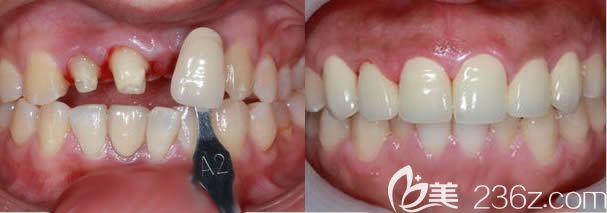 厦门登特口腔候红医生美容冠案例效果对比图 厦门登特口腔候红医生美容冠案例效果对比图