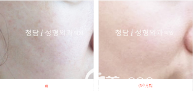 韩国清潭i整形外科李钟浩面部皮肤治疗术前术后效果对比图