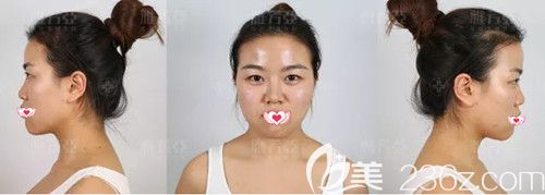 在石家庄雅芳亚做眼鼻整形术前有凸嘴问题 在石家庄雅芳亚做眼鼻整形术前有凸嘴问题