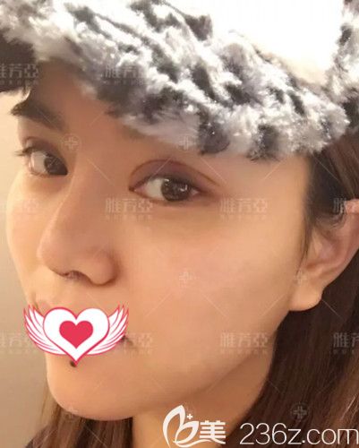 在石家庄雅芳亚做眼鼻整形术后7天进行拆线 在石家庄雅芳亚做眼鼻整形术后7天进行拆线