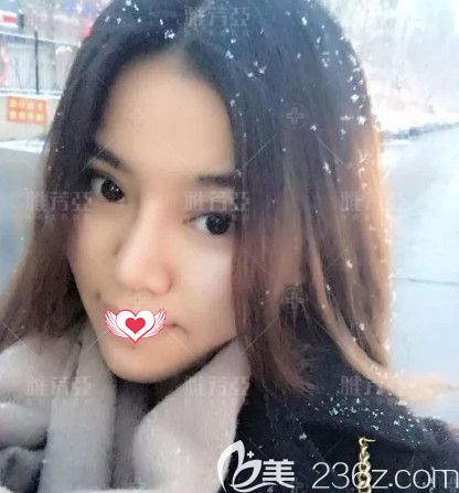 雅芳亚整形院长王文明为我做眼鼻整形术后18天恢复差不多 雅芳亚整形院长王文明为我做眼鼻整形术后18天恢复差不多