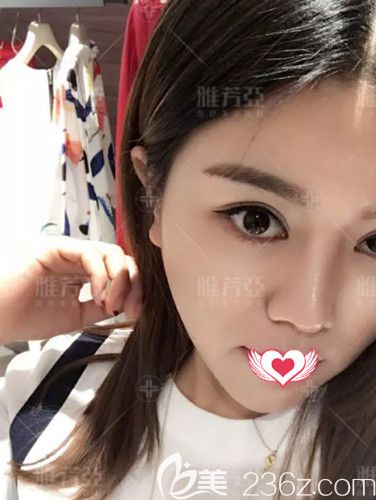 在石家庄雅芳亚做眼鼻整形术后26天已经消肿 在石家庄雅芳亚做眼鼻整形术后26天已经消肿