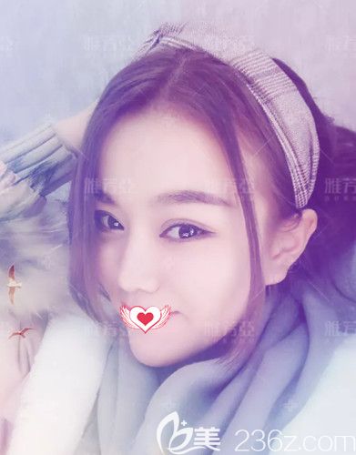 王文明院长为我做双眼皮和鼻综合术后改善凸嘴问题 王文明院长为我做双眼皮和鼻综合术后改善凸嘴问题