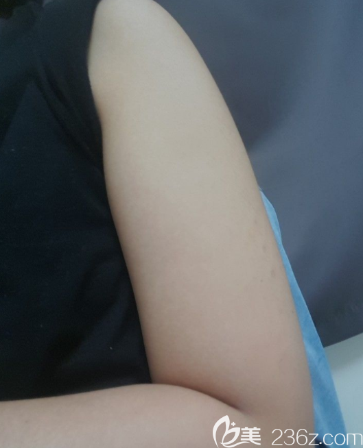 术前胳膊 术前胳膊