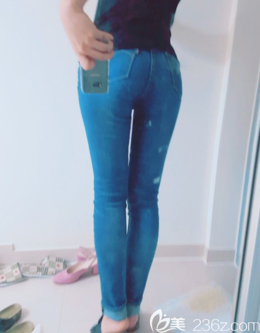 维摩整形外科姜在九吸脂案例 维摩整形外科姜在九吸脂案例