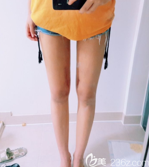 姜在九做吸脂好吗 姜在九做吸脂好吗