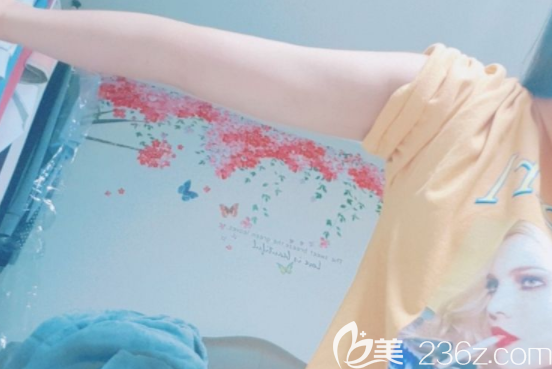 吸脂后手臂 吸脂后手臂