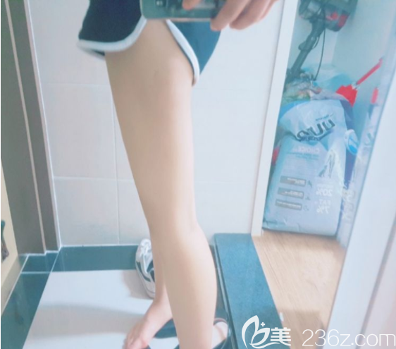 吸脂术后三个月 吸脂术后三个月