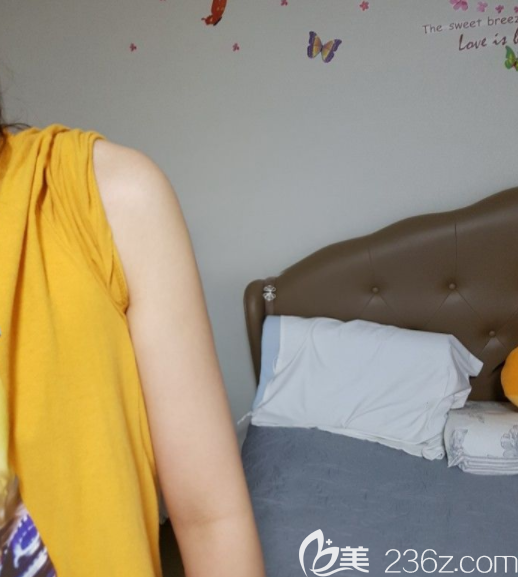 吸脂一个月 吸脂一个月