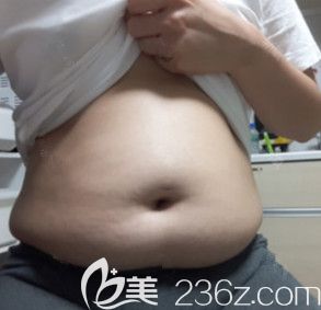 在韩国365mc整形医院做完吸脂手术前 在韩国365mc整形医院做完吸脂手术前