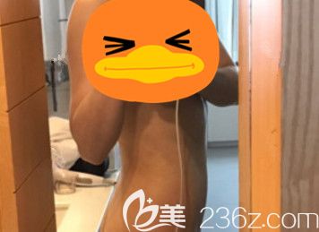 在韩国365mc整形医院做完吸脂手术后1个月 在韩国365mc整形医院做完吸脂手术后1个月