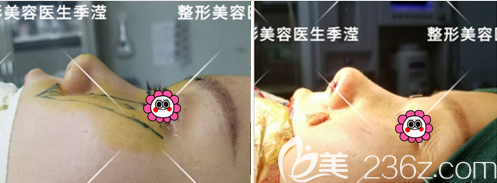 北京艺星季滢医生肋软骨隆鼻+垫鼻基底案例