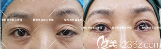 北京艺星季滢医生双眼皮修复案例