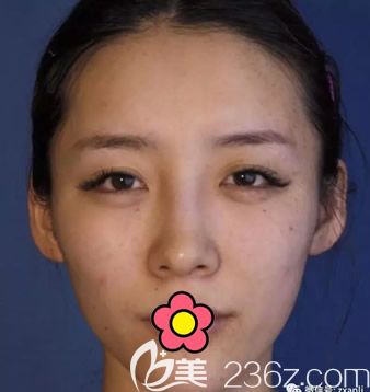 呼和浩特张高贵医疗美容门诊部张高贵术前照片1