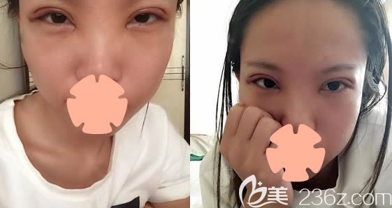 在长春奥拉克整形做双眼皮+开眼角术后4天照