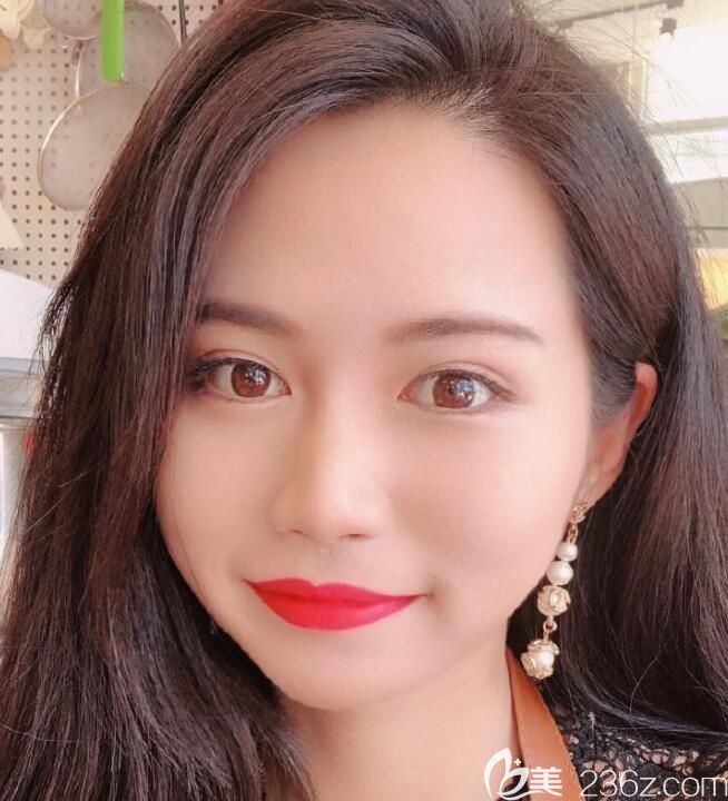 找田耿莉做全脸埋线提升前 找田耿莉做全脸埋线提升前