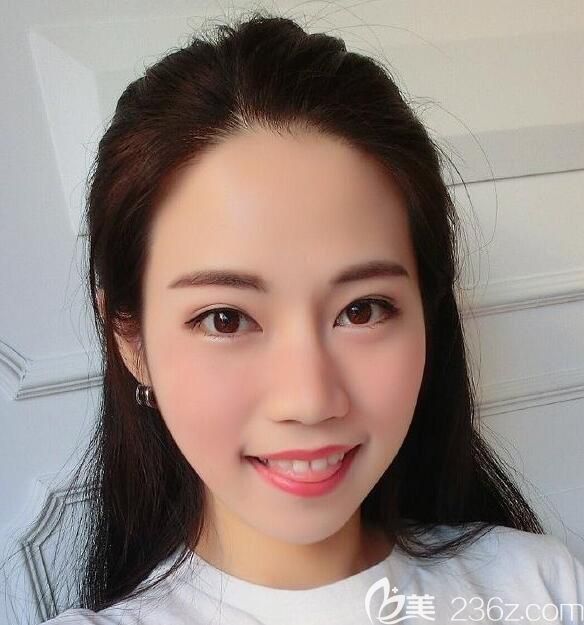 合肥壹美尚全脸线雕术后第3天 合肥壹美尚全脸线雕术后第3天