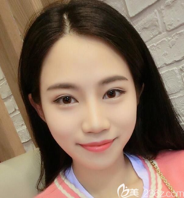 壹美尚脸部埋线提升第7天恢复情况 壹美尚脸部埋线提升第7天恢复情况