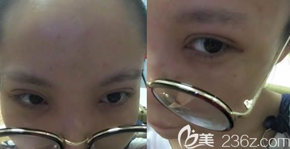 在长春奥拉克做双眼皮+开眼角术后7天照
