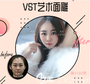 北京京韩乔爱军医生VST艺术面雕案例 北京京韩乔爱军医生VST艺术面雕案例