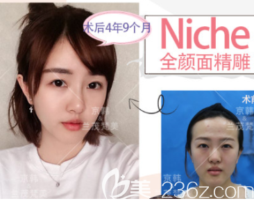 北京京韩乔爱军医生NIC抗衰老面雕案例 北京京韩乔爱军医生NIC抗衰老面雕案例