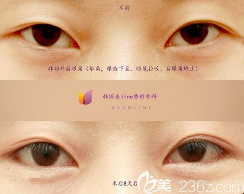 韩国美line非切开眼综合案例 韩国美line非切开眼综合案例