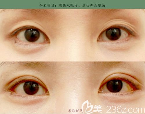韩国美line埋线双眼皮+开后眼角案例 韩国美line埋线双眼皮+开后眼角案例