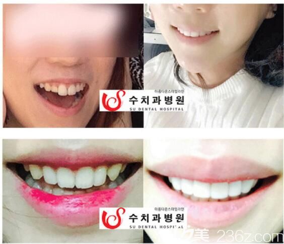 韩国SU牙科医院瓷贴面<span style= 韩国SU牙科医院瓷贴面<span style=