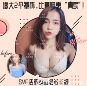 北京京韩王沛森自体脂肪隆胸案例 北京京韩王沛森自体脂肪隆胸案例