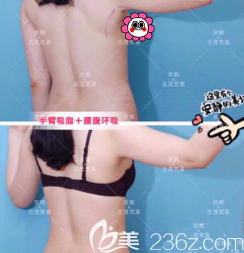 北京京韩王沛森手臂腰腹吸脂案例 北京京韩王沛森手臂腰腹吸脂案例
