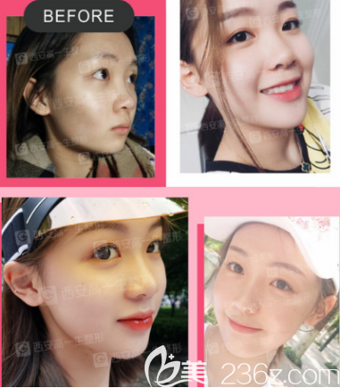 西安高一生自体脂肪填充面部案例2