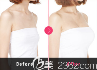 魔笛假体隆胸真人案例前后效果对比图