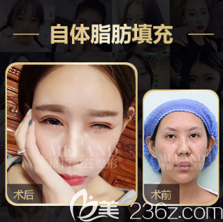 济南美莲整形医院自体脂肪填充案例