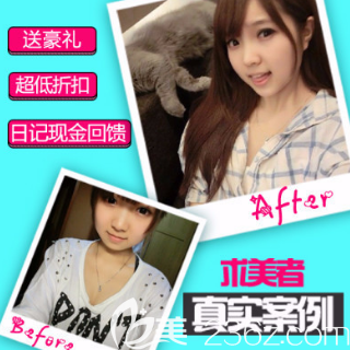 济南历下宝琳娜自体脂肪填充面部案例