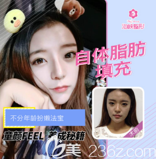 济南海峡自体脂肪填充面部案例