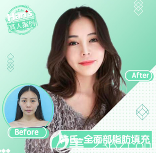 济南韩氏自体脂肪填充面部案例