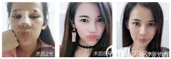 曾高医生隆鼻案例 曾高医生隆鼻案例