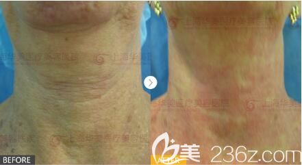 <!--<i data=20240703-sp></li>
<li><i data=20240703-sp></i>-->华美医疗美容医院 4D极塑提拉真人案例