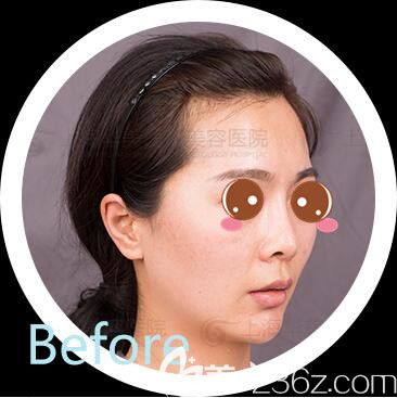 <!--<i data=20240703-sp></li>
<li><i data=20240703-sp></i>-->华美ARC™金标准脂肪塑性+肋软骨鼻综合真人案例术前照