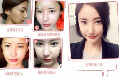 京韩自体脂肪填充面部案例