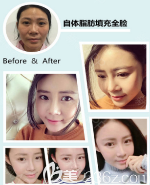 烟台洛神自体脂肪填充面部案例