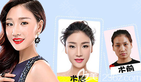 烟台鹏爱医院自体脂肪填充案例