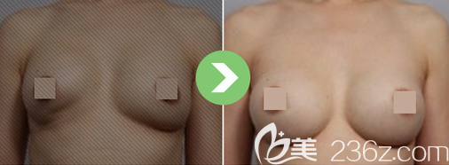 韩国麦恩李圣郁隆胸失败修复案例效果对比图