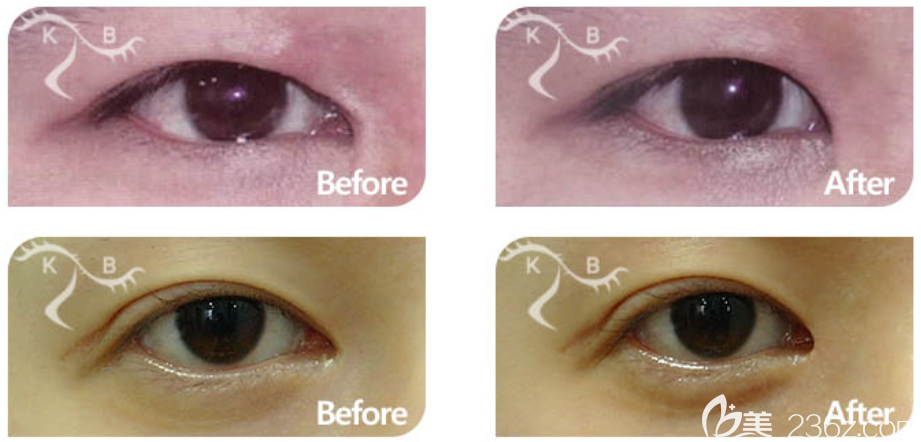 韩国KB整形外科权钉镐双眼皮失败修复案例效果对比图