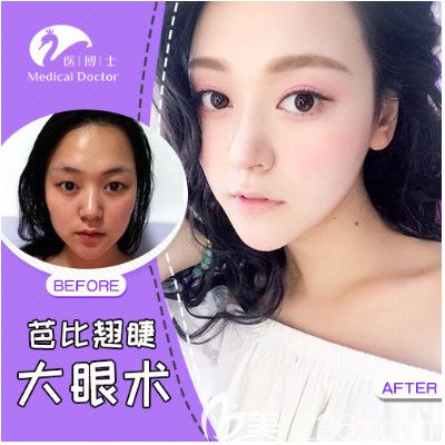 佛山医博士刘哲医生双眼皮案例 佛山医博士刘哲医生双眼皮案例