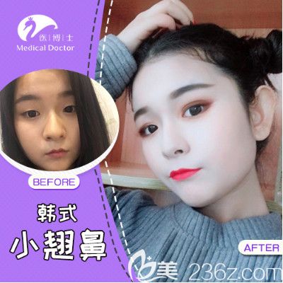 佛山医博士门诊刘哲隆鼻案例 佛山医博士门诊刘哲隆鼻案例