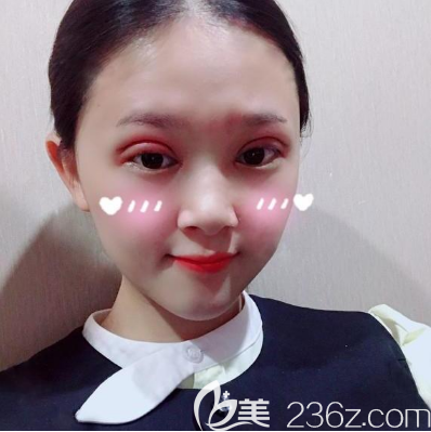 在佛山医博士做完全切双眼皮两天了