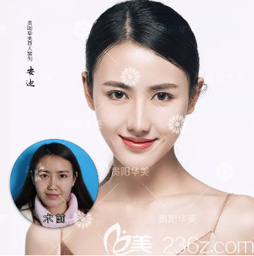 贵阳华美鼻综合案例