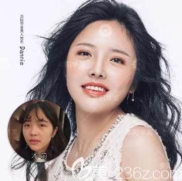 贵阳华美自体脂肪全脸填充效果好不好